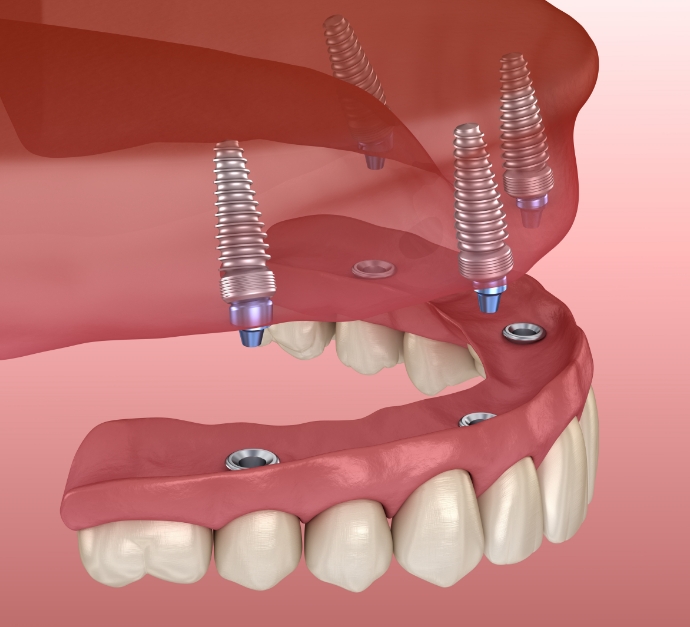Illustration of All on 4 implant denture in Staten Island being placed on upper arch