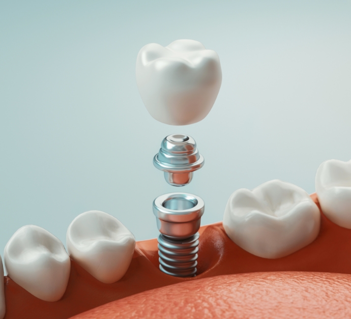 Illustration of dental implant in Staten Island replacing a missing lower tooth