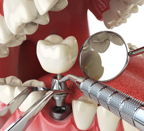 Illustrated dental implant being placed in lower jaw