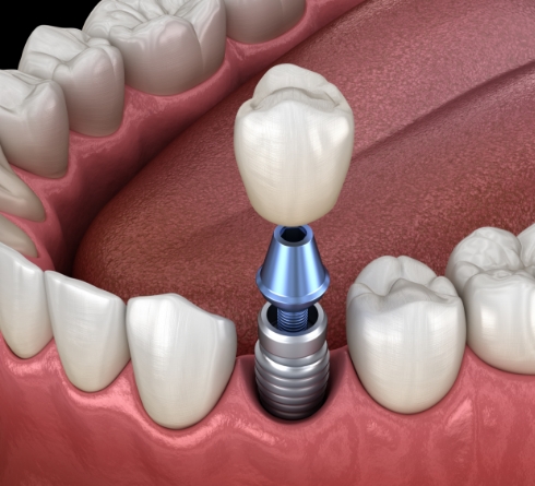 Illustrated dental crown being placed onto a dental implant