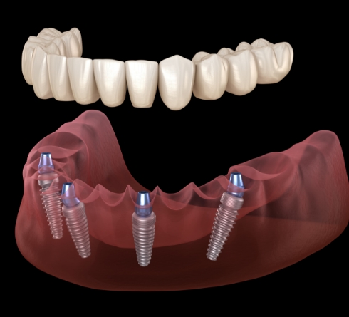 Illustrated full denture being placed onto four dental implants