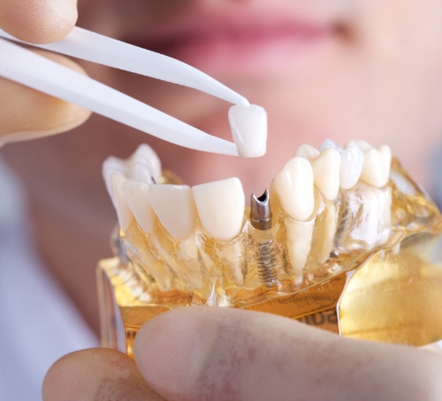 Dentist placing a crown over a dental implant in a model of the mouth