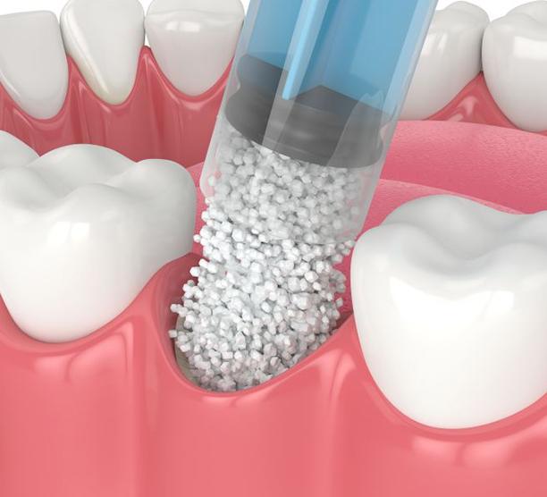 Illustration of bone graft being placed in empty tooth socket