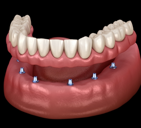 Illustrated full denture being placed onto six dental implants