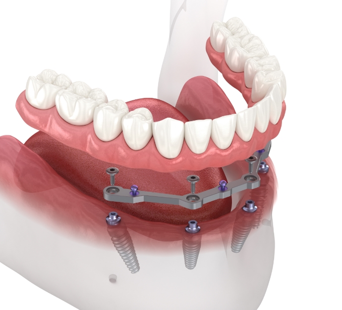 Illustrated full denture being placed onto four dental implants