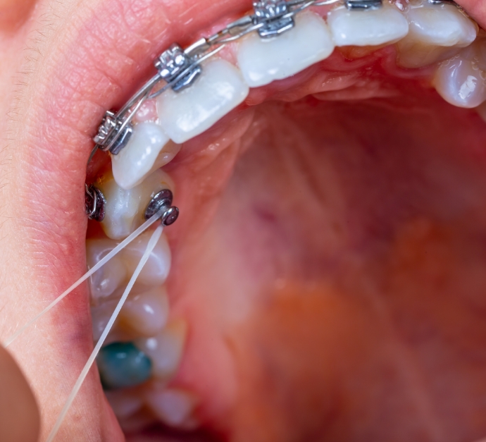 Close up of mouth receiving impacted canine oral surgery in Staten Island