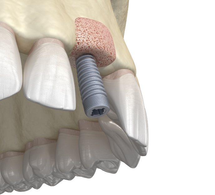 Illustrated dental implant in area of jawbone with bone grafting material