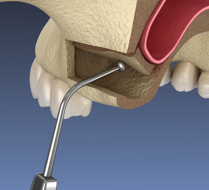 Illustrated surgical instrument lifting the sinus membrane