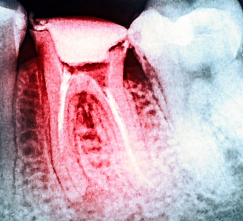 X ray of teeth with one tooth highlighted red