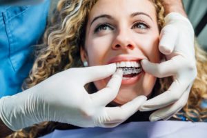 a woman getting Invisalign placed at the dentist