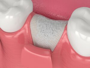 Illustration of a tooth socket with a bone graft