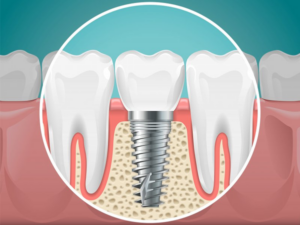 Digital image of a dental implant placed in the jawbone