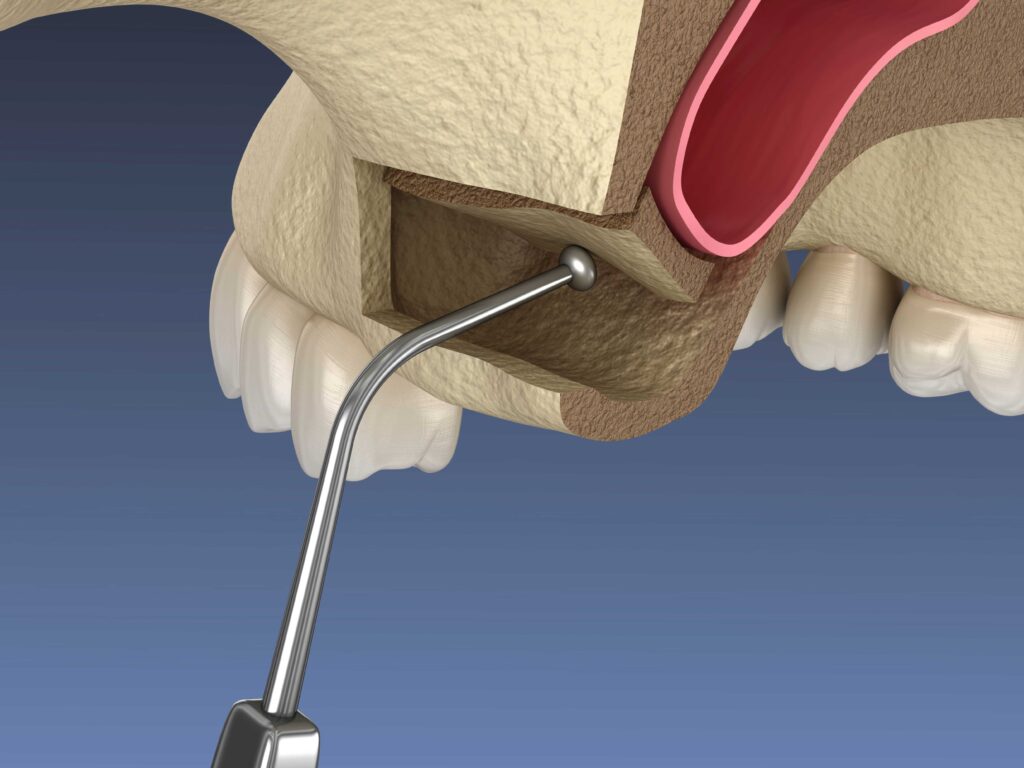 Sinus lift